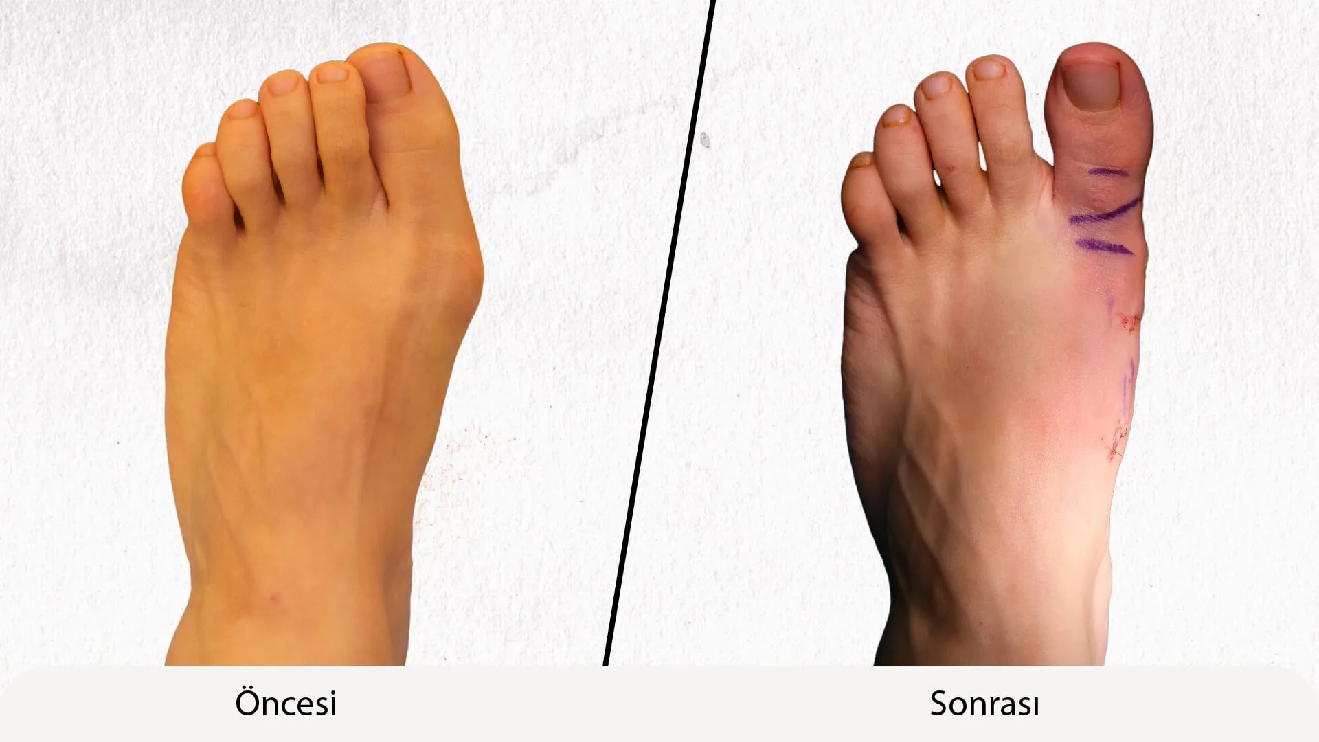 Anasayfa 5 Minimal invaziv oncesi sonrasi Calisma Yuzeyi 1